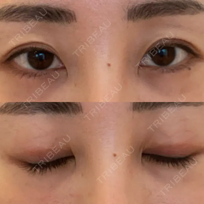 上まぶたたるみ取り e:Top clinic（イートップクリニック） AFTER メイン用