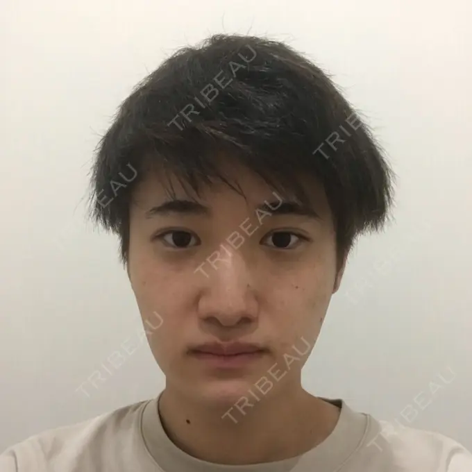 糸リフト / あごプロテーゼ 湘南美容クリニック 上野院 DAY 33 メイン用