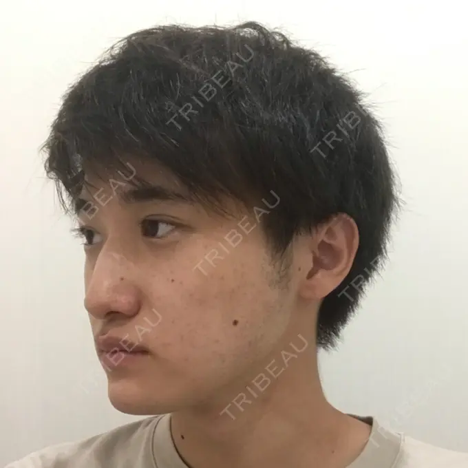 糸リフト / あごプロテーゼ 湘南美容クリニック 上野院 DAY 33 メイン用