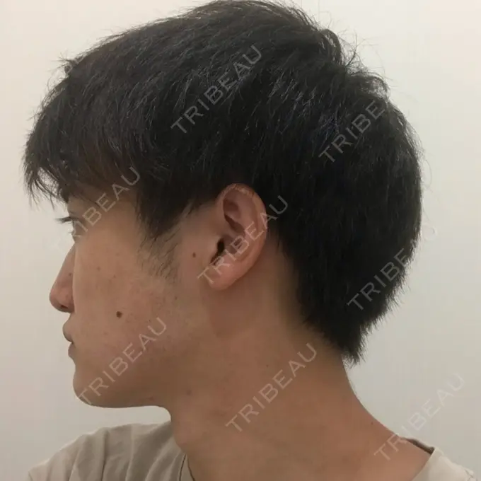 糸リフト / あごプロテーゼ 湘南美容クリニック 上野院 DAY 33 メイン用