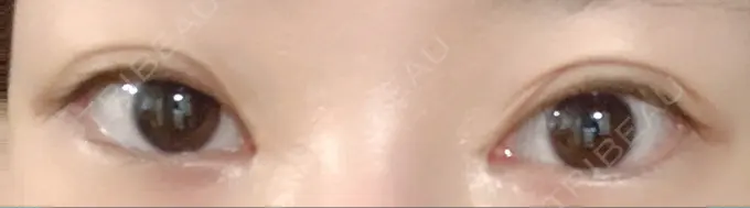 二重切開 / 目頭切開 / 上まぶたの脂肪取り MIL CLINIC OSAKA AFTER メイン用