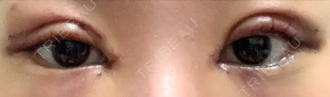 二重切開 / 目頭切開 / 上まぶたの脂肪取り MIL CLINIC OSAKA DAY 2 メイン用