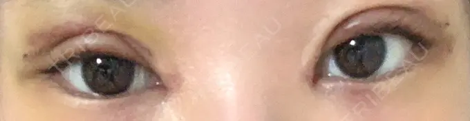 二重切開 / 目頭切開 / 上まぶたの脂肪取り MIL CLINIC OSAKA DAY 6 メイン用