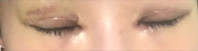 二重切開 / 目頭切開 / 上まぶたの脂肪取り MIL CLINIC OSAKA DAY 9 メイン用