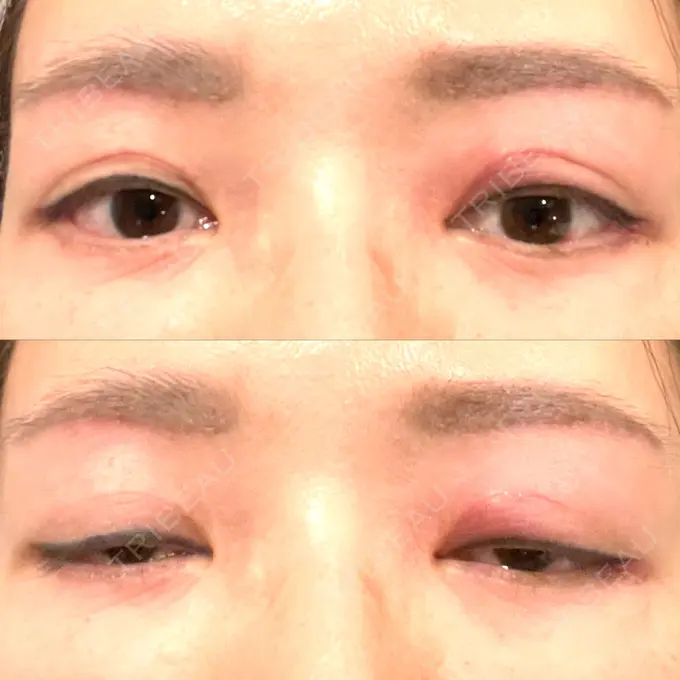 二重切開 / 眼瞼下垂（切開） / 下まぶたたるみ取り / 眉下切開 e:Top clinic（イートップクリニック） DAY 35 メイン用