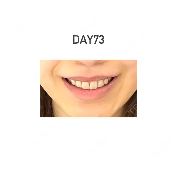 人中短縮 新宿ラクル美容外科クリニック 新宿院 DAY 73 メイン用