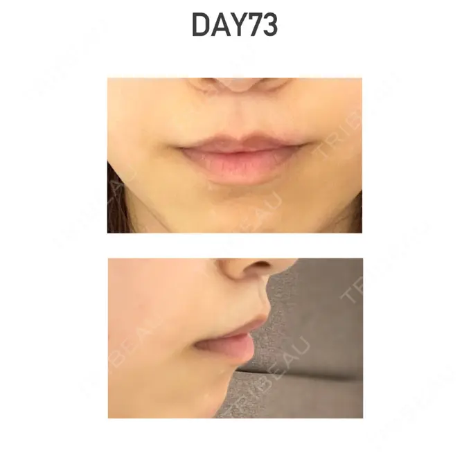 人中短縮 新宿ラクル美容外科クリニック 新宿院 AFTER メイン用