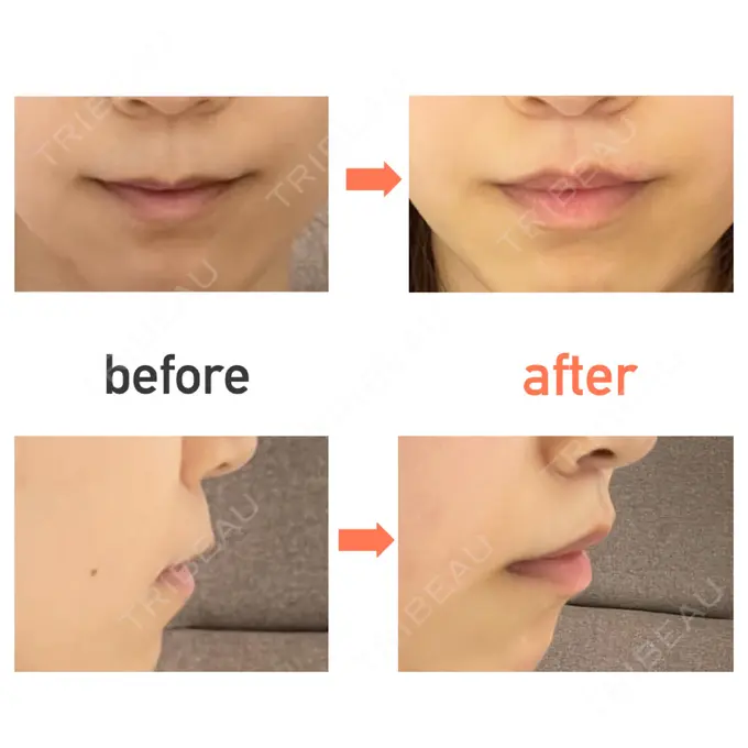 人中短縮 新宿ラクル美容外科クリニック 新宿院 DAY 73 メイン用