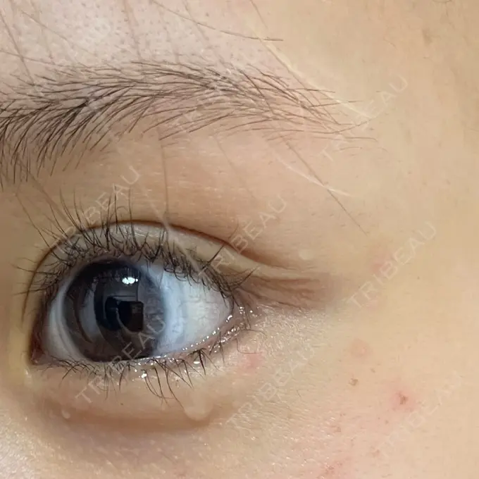 ほくろ・いぼ除去レーザー（肌） Fellez Clinic【フェルズクリニック】 AFTER メイン用