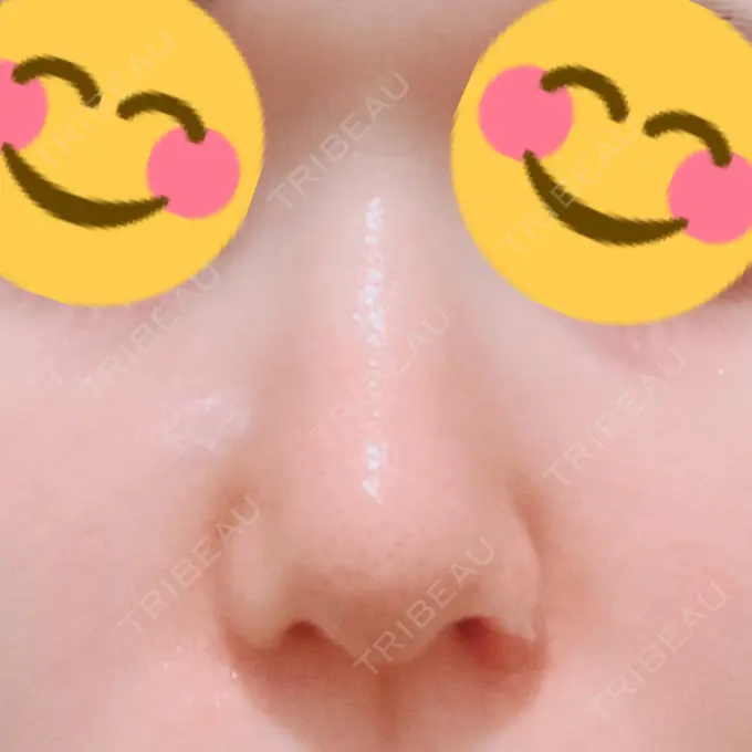 鼻孔縁挙上 シエルクリニック DAY 13 メイン用