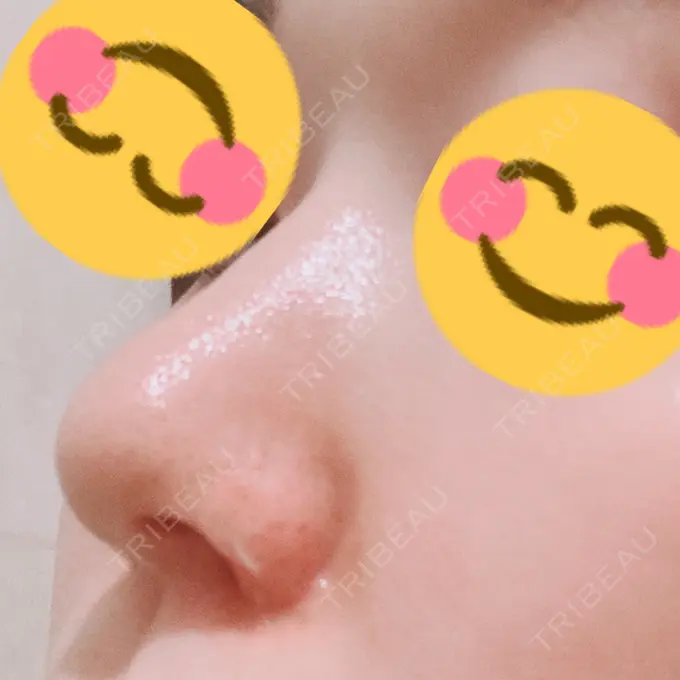 鼻孔縁挙上 シエルクリニック DAY 13 メイン用