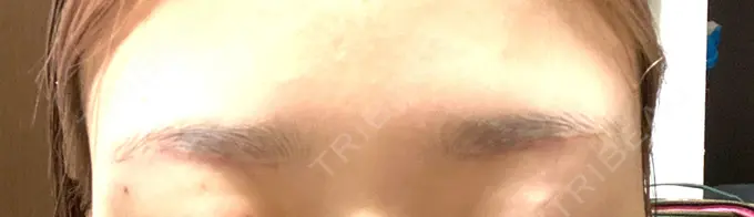 上まぶたの脂肪取り / 眉下切開 e:Top clinic（イートップクリニック） DAY 24 メイン用