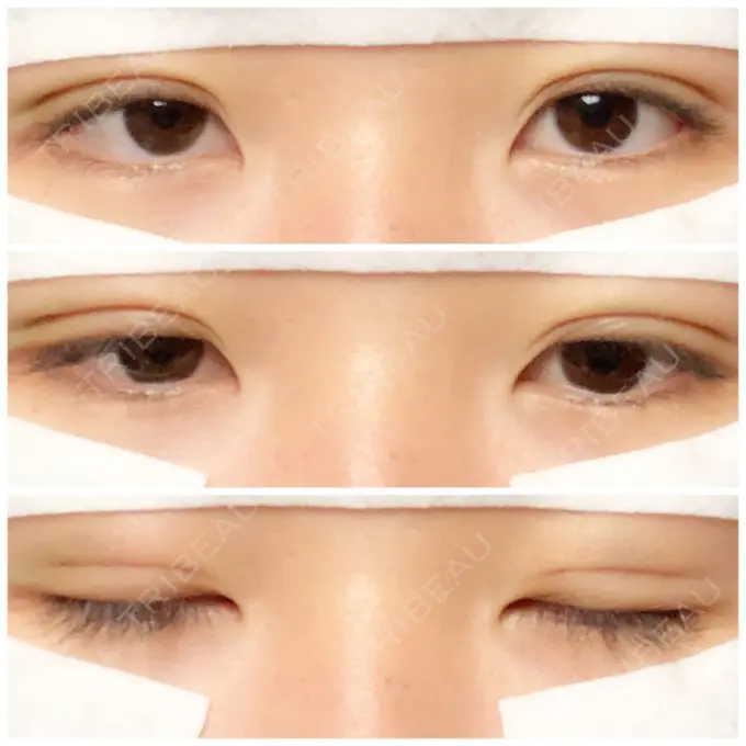 二重埋没 湘南美容クリニック 長野院 DAY 3 メイン用