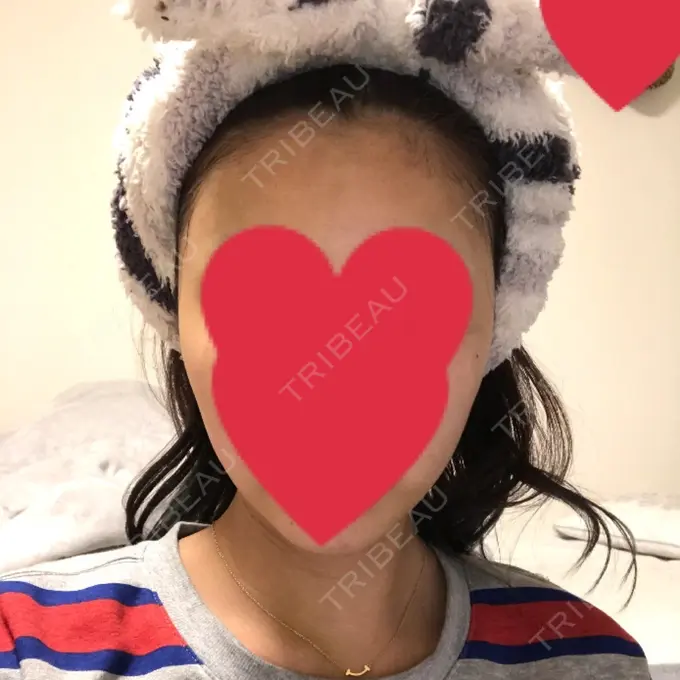 バッカルファット除去 / 脂肪吸引（顔） / 額を丸く / ヒアルロン酸注入（あご） / ボトックス（エラ・小顔） / ヒアルロン酸注入（額） エートップ美容整形外科 DAY 8 メイン用