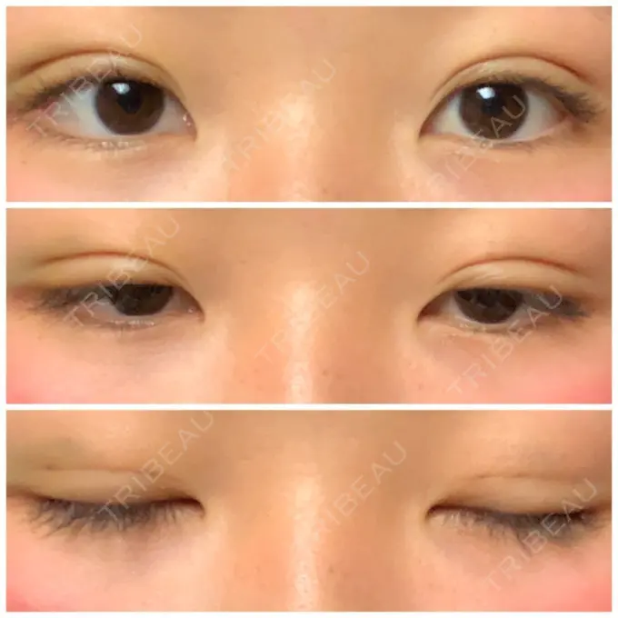 二重埋没 湘南美容クリニック 長野院 DAY 4 メイン用