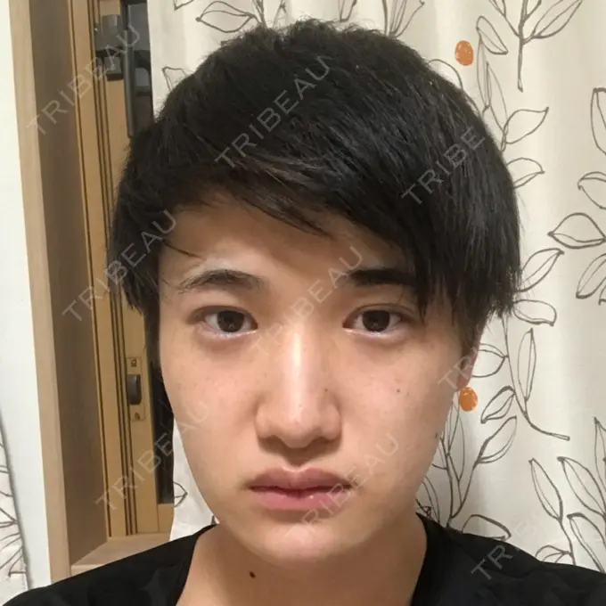 糸リフト / あごプロテーゼ 湘南美容クリニック 上野院 DAY 40 メイン用