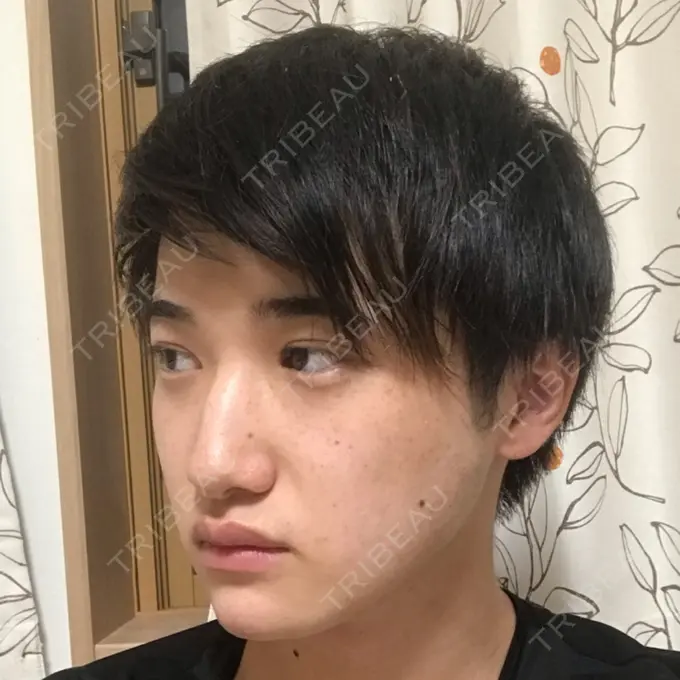 糸リフト / あごプロテーゼ 湘南美容クリニック 上野院 DAY 40 メイン用