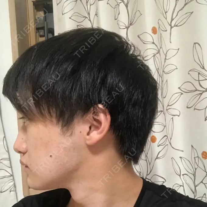 糸リフト / あごプロテーゼ 湘南美容クリニック 上野院 DAY 40 メイン用