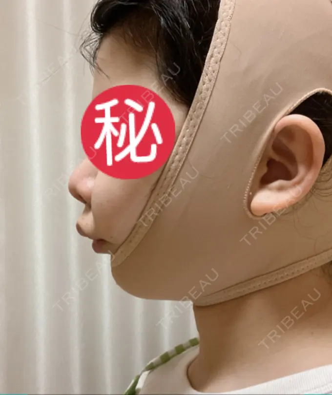 目頭切開 / 小鼻縮小（切開） / バッカルファット除去 / 脂肪吸引（顔） / 人中短縮 / ボトックス（ガミースマイル） / その他（鼻） / その他（口元） ルラ美容クリニック 名古屋本院 DAY 8 メイン用