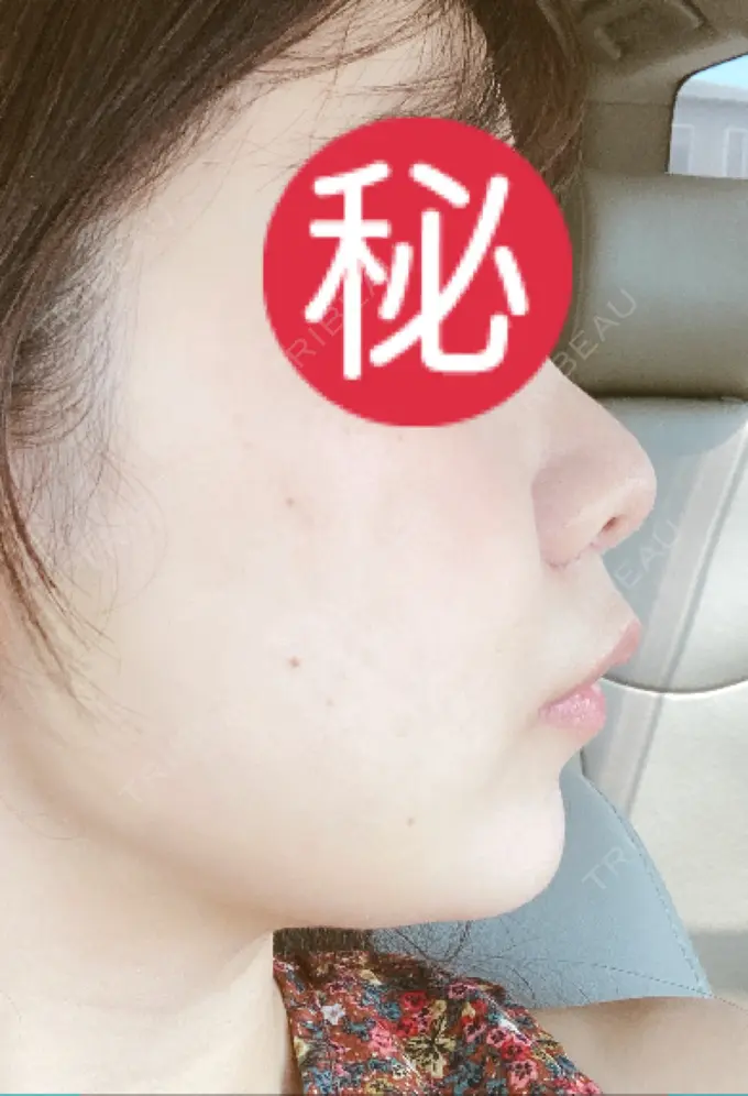 目頭切開 / 小鼻縮小（切開） / バッカルファット除去 / 脂肪吸引（顔） / 人中短縮 / ボトックス（ガミースマイル） / その他（鼻） / その他（口元） ルラ美容クリニック 名古屋本院 AFTER メイン用