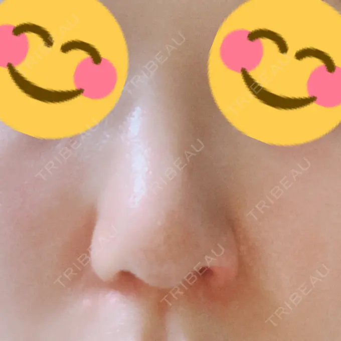 鼻孔縁挙上 シエルクリニック AFTER メイン用