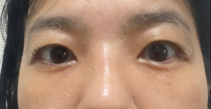 クマ治療 / 下まぶたたるみ取り セオリークリニック DAY 56 メイン用