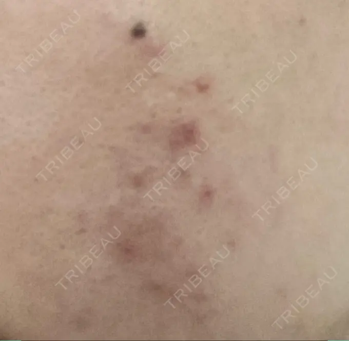 アグネス つばめ美容クリニック DAY 6 メイン用