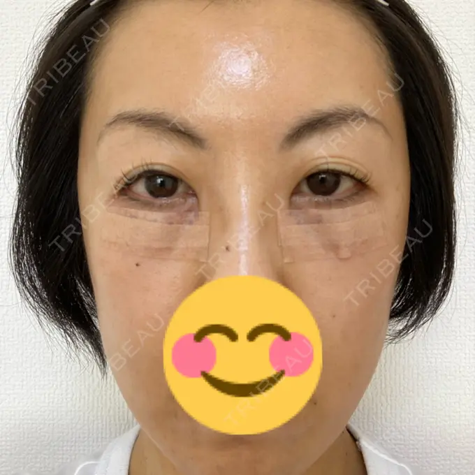 下まぶたたるみ取り 吉井クリニック DAY 1 メイン用