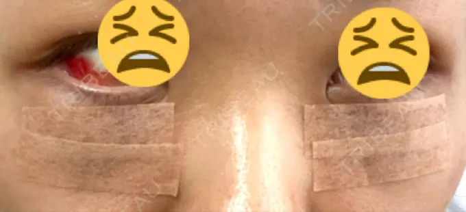 下まぶたの脂肪取り 吉井クリニック DAY 1 メイン用