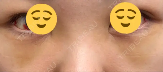 下まぶたの脂肪取り 吉井クリニック DAY 4 メイン用