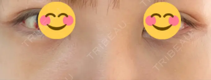 下まぶたの脂肪取り 吉井クリニック DAY 5 メイン用