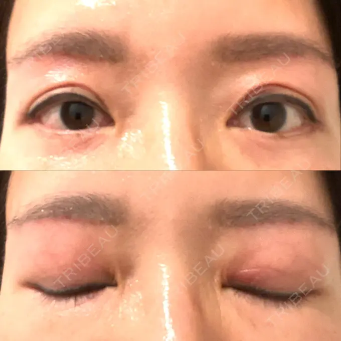二重切開 / 眼瞼下垂（切開） / 下まぶたたるみ取り / 眉下切開 e:Top clinic（イートップクリニック） DAY 47 メイン用