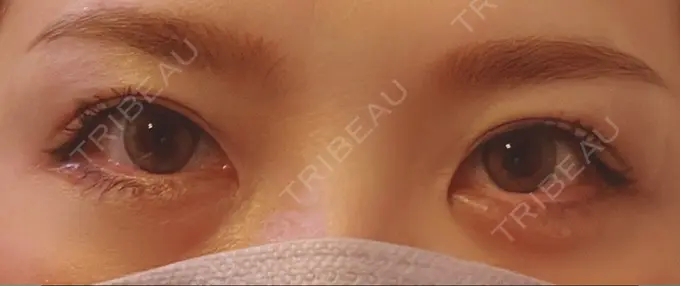 ヒアルロン酸注入（涙袋） / ボトックス（眉間） TCB東京中央美容外科 心斎橋院 DAY 231 メイン用