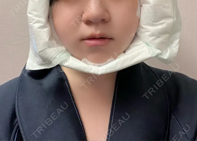 脂肪吸引（顔） THE CLINIC（ザ・クリニック） 福岡院 DAY 0 メイン用