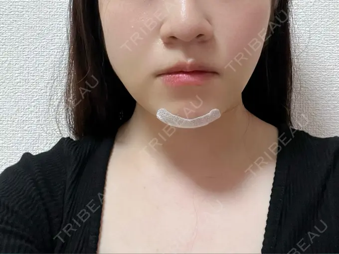 脂肪吸引（顔） THE CLINIC（ザ・クリニック） 福岡院 DAY 1 メイン用