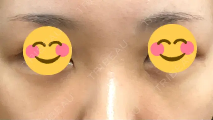 下まぶたの脂肪取り 吉井クリニック DAY 7 メイン用