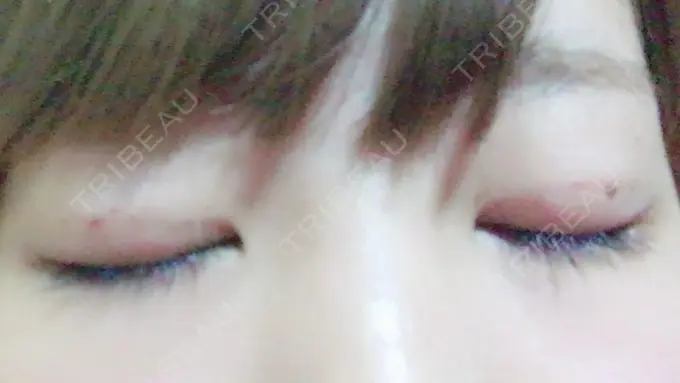 二重埋没 品川スキンクリニック広島院 DAY 17 メイン用