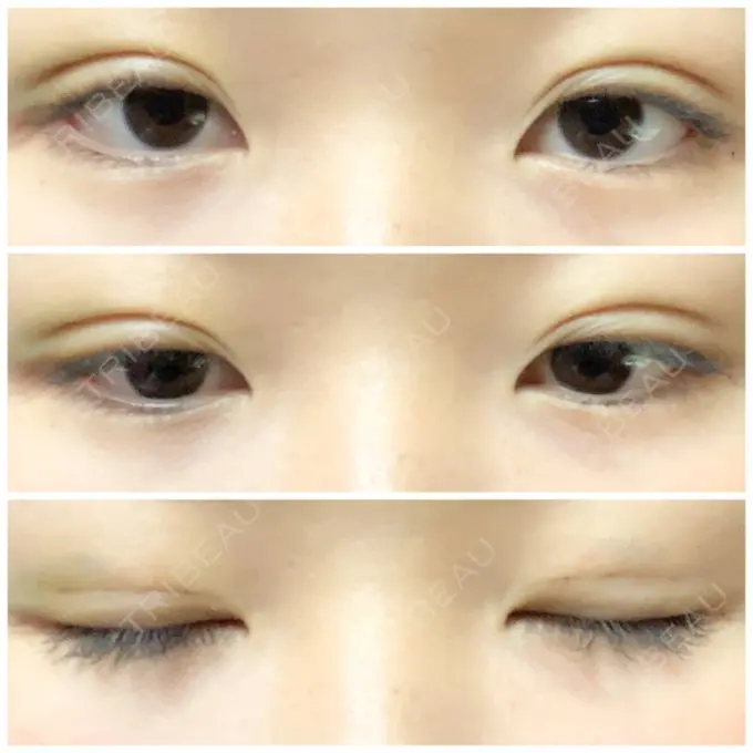 二重埋没 湘南美容クリニック 長野院 DAY 4 メイン用