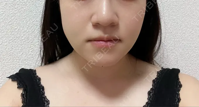 脂肪吸引（顔） THE CLINIC（ザ・クリニック） 福岡院 DAY 2 メイン用