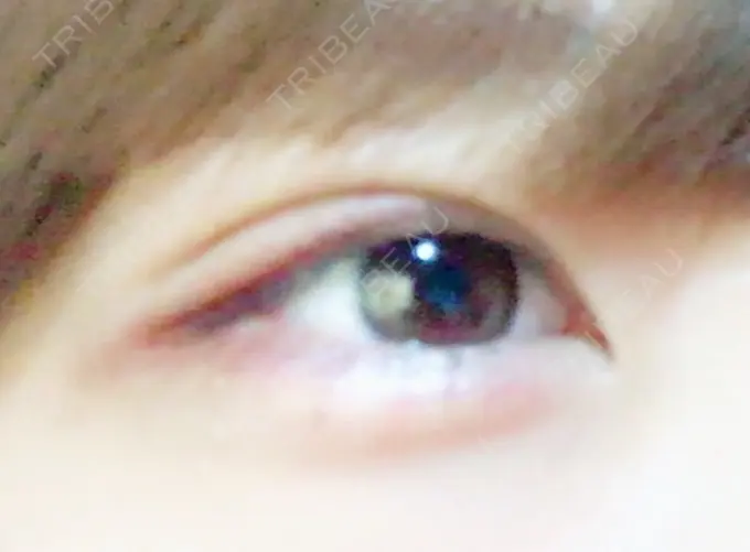 二重埋没 品川スキンクリニック広島院 DAY 17 メイン用