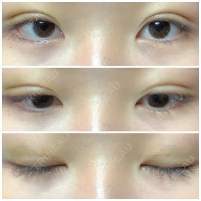 二重埋没 湘南美容クリニック 長野院 DAY 5 メイン用