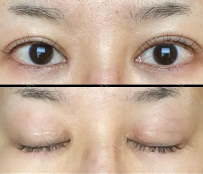 二重切開 / 目頭切開 湘南美容クリニック 六本木院 AFTER メイン用