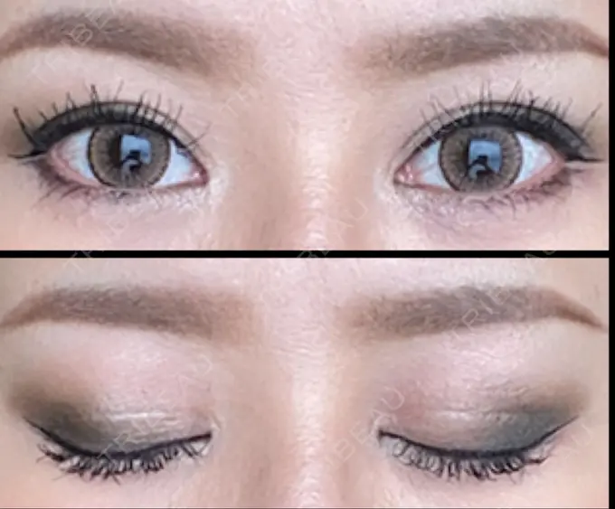 二重切開 / 目頭切開 湘南美容クリニック 六本木院 DAY 150 メイン用