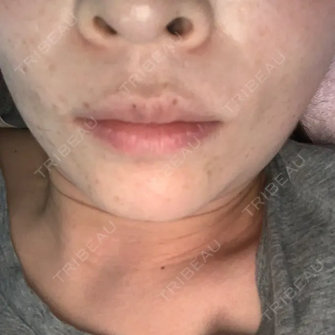 肌ヒアルロン酸注入（たるみ・シワ改善） / その他（鼻） TCB東京中央美容外科 郡山院 AFTER メイン用