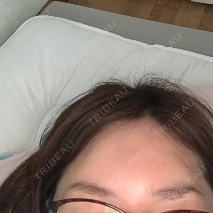 ヒアルロン酸注入（額） / ボトックス（眉間） TCB東京中央美容外科 郡山院 AFTER メイン用