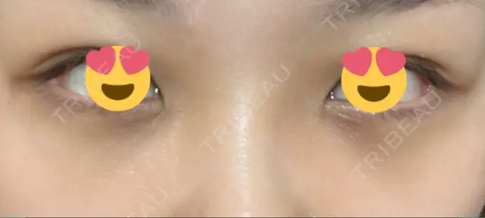 下まぶたの脂肪取り 吉井クリニック AFTER メイン用