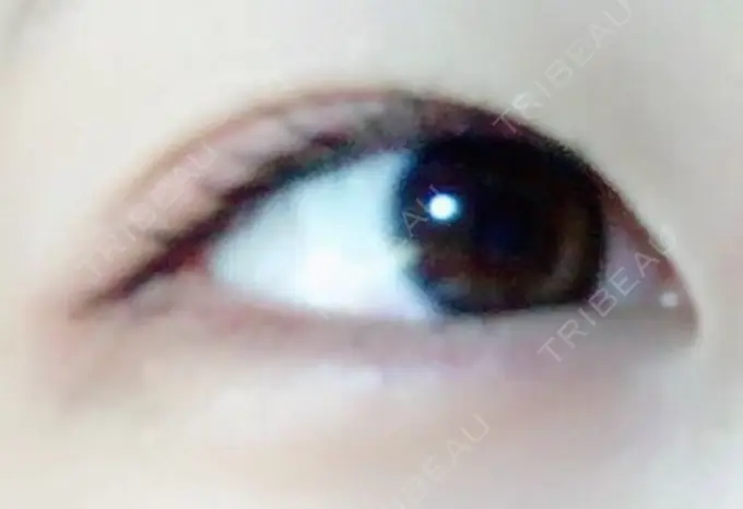 二重埋没 品川スキンクリニック広島院 DAY 24 メイン用