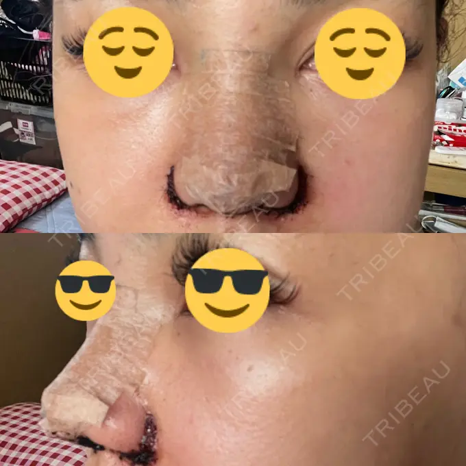 鼻中隔延長（切開） / 眉間プロテーゼ / 鼻尖縮小 / 鼻尖形成（非切開） YBC横浜美容外科 大宮院 DAY 2 メイン用