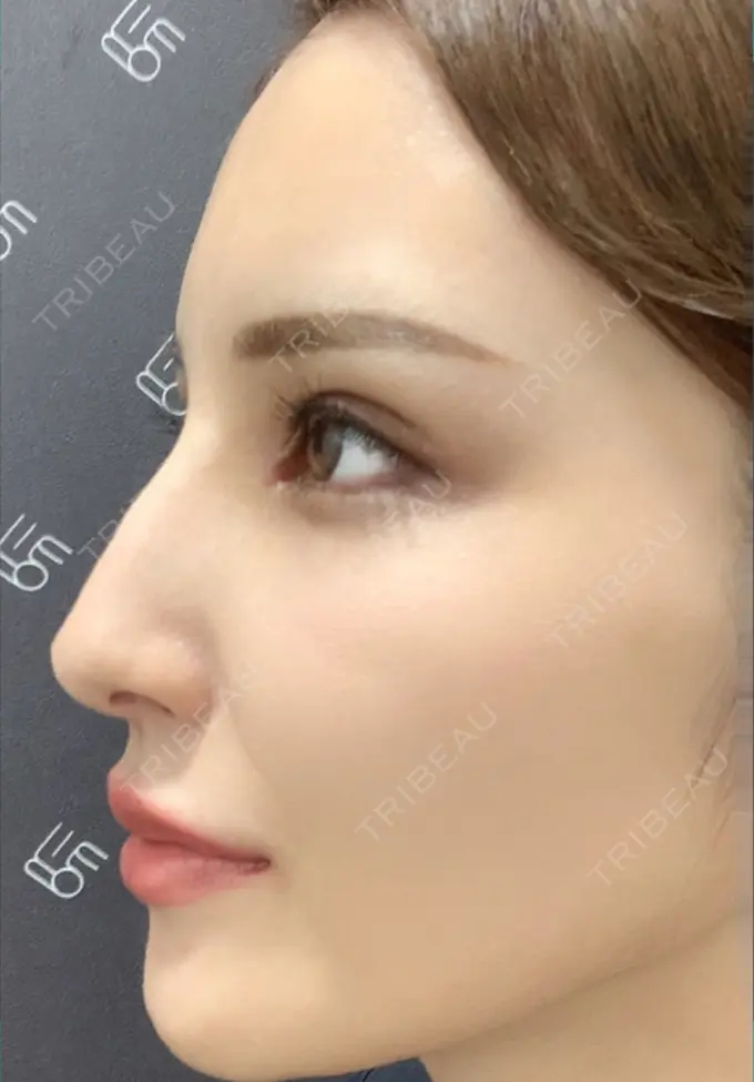 人中短縮 / ヒアルロン酸注入（唇） / ボトックス（口角） EMMO FACE CLINIC 大宮院 DAY 35 メイン用