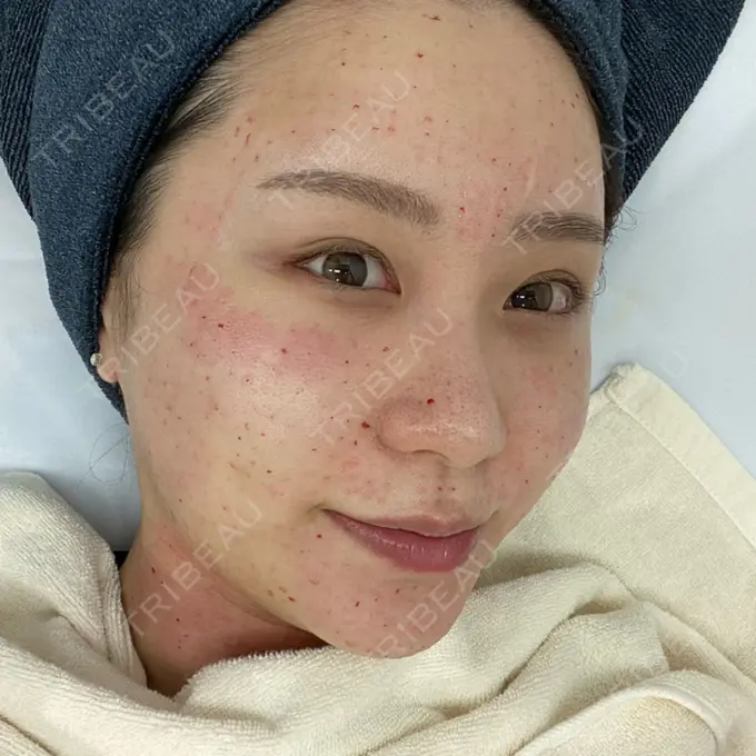 水光注射（ハリ・美肌） STARS CLINIC DAY 0 メイン用